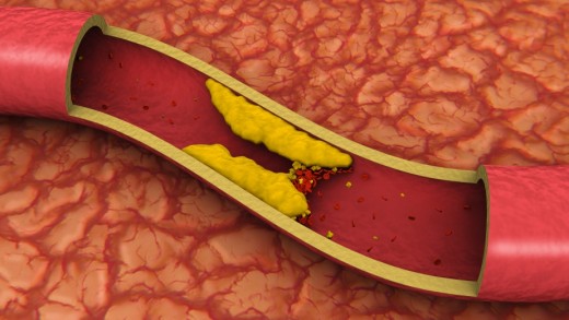Krvni sud holesterol