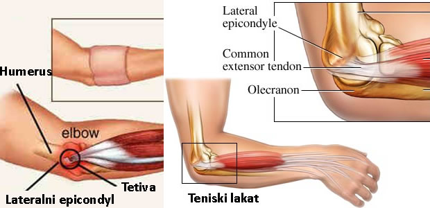 bol u laktu s vanjske strane kad bol odmiče s artrozom zgloba koljena