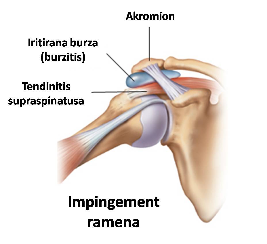 bol u ramenskom zglobu u mirovanju baralgin se može koristiti za bolove u zglobovima